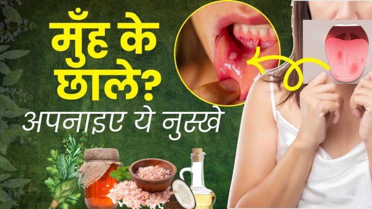 Home Remedies for Blisters: घर बैठे करे छालो का जड़ से खत्म, यहाँ जाने छालों की देसी Home Remedies…